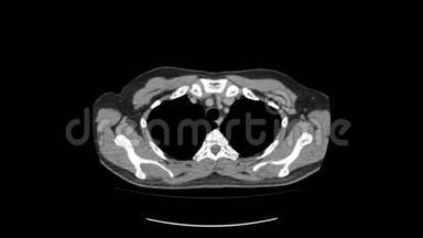 上腹部顶部CT扫描